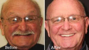 The before and after photos of a cancer survivor's dental treatment.