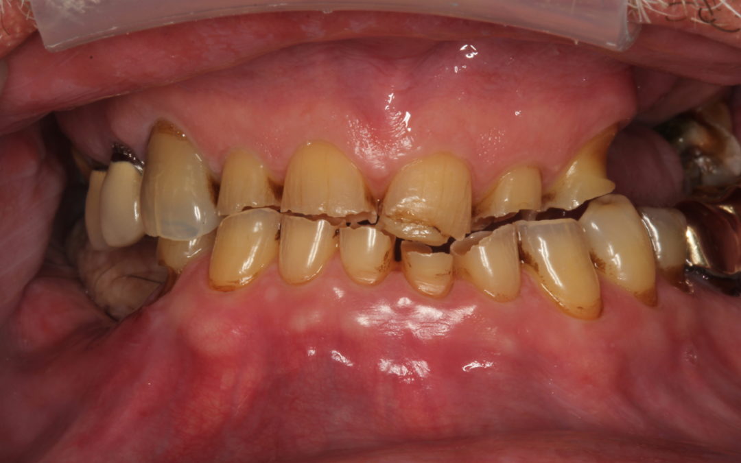 Cancer Survivor Case Study: Denture Rehab for Missing Teeth