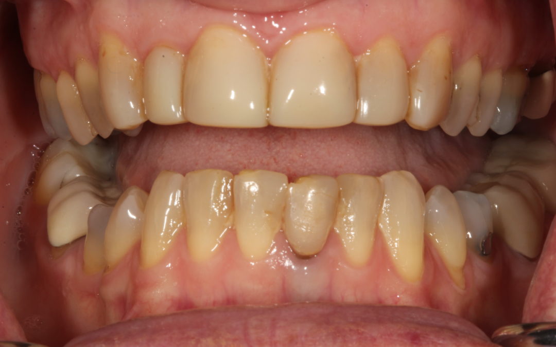 “Won’t my insurance cover this?”–  Anterior All-Ceramic From Case Selection to Cementation