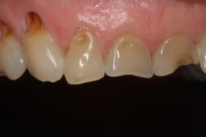 Abfraction and erosion due to swishing - dental occlusion