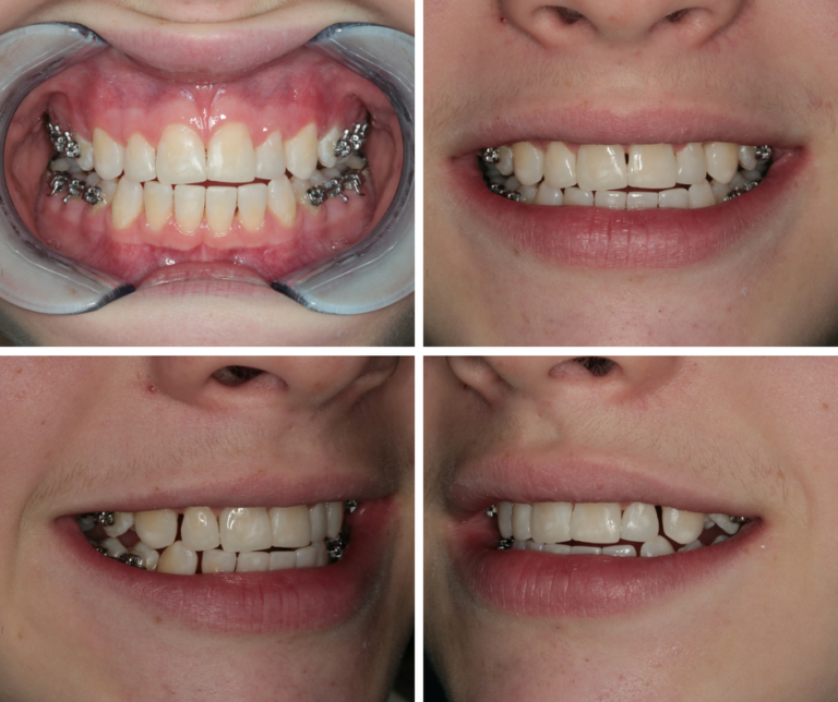 4 Inspirational Dental Cases: Restoration, Veneers, Ectodermal Dysplasia