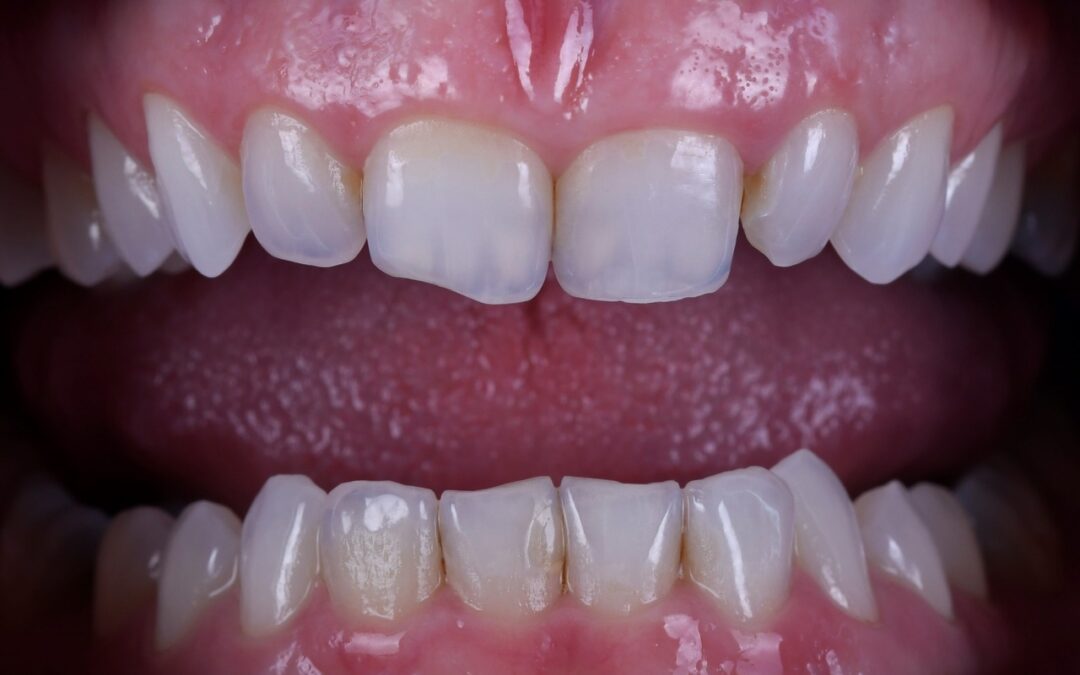 Function Trumps Aesthetics – How to Achieve Both in a 10 unit Smile Design