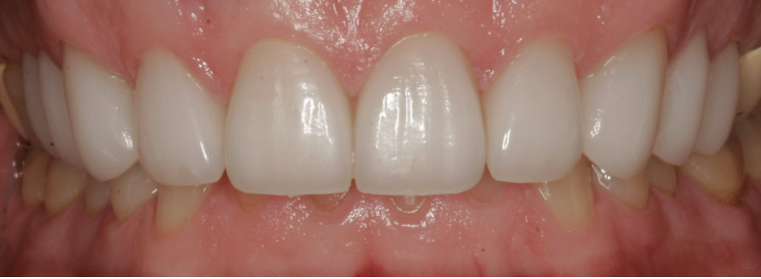 Achieving Dream Esthetics with Veneers: A Case Study by Dr. John Nosti