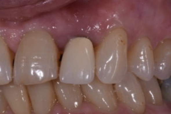 Rescuing Aged or ‘Imperfect’ Teeth”: A Case Study by Dr. Eric Farmer