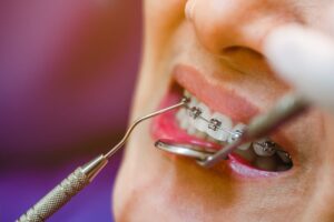 Full-Mouth Restoration in Colleyville