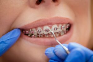 Full-Mouth Restoration in Grapevine